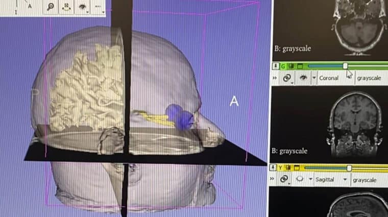 A 3D human head outline with slices in the axial, sagittal, and coronal directions. Eyeballs and brain are present in the image as 3D objects.