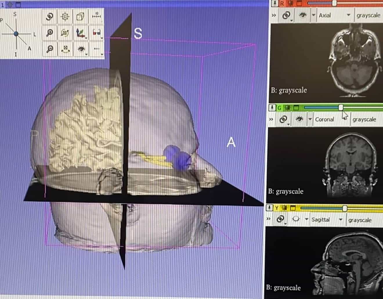 A 3D human head outline with slices in the axial, sagittal, and coronal directions. Eyeballs and brain are present in the image as 3D objects.